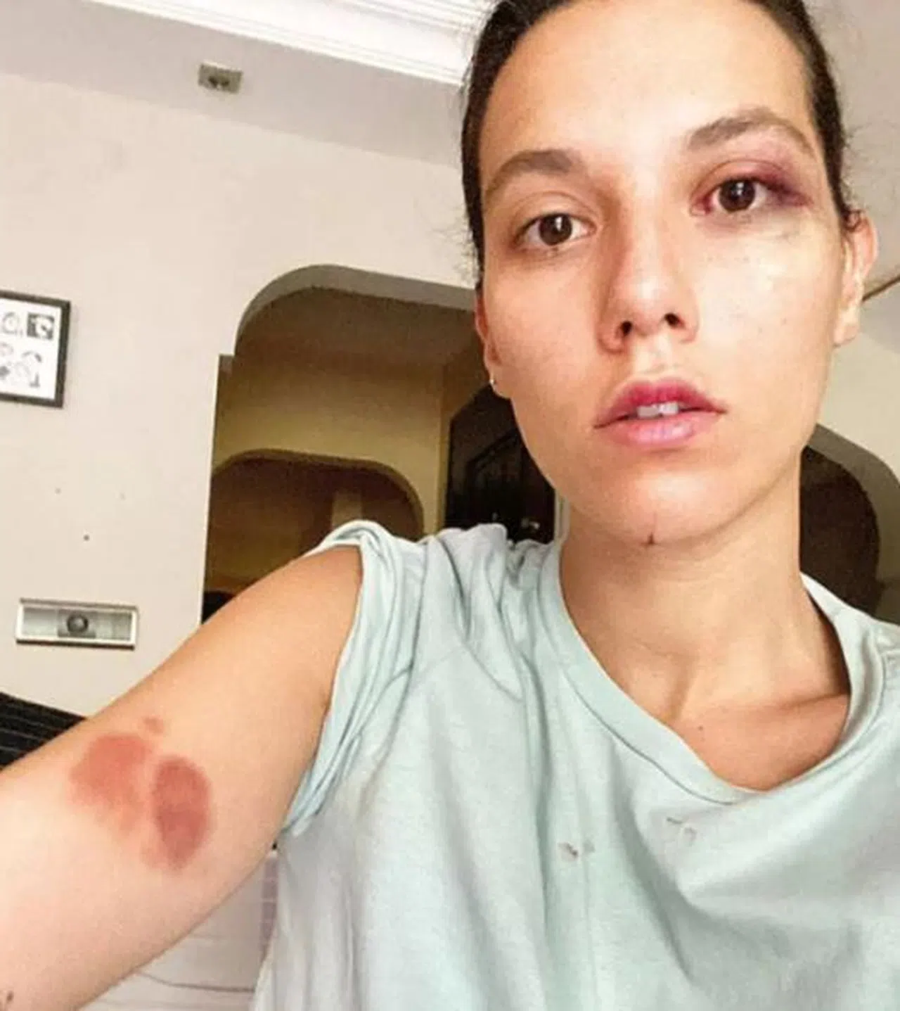 Deniz Bulutsuz ve Ozan Güven arasındaki şiddet davasında adli tıp raporu mahkemeye ulaştı!