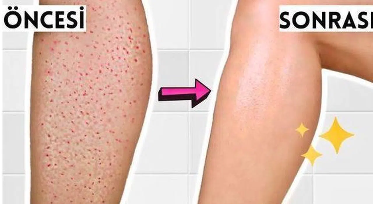 Çilek Bacak Nasıl Geçer?