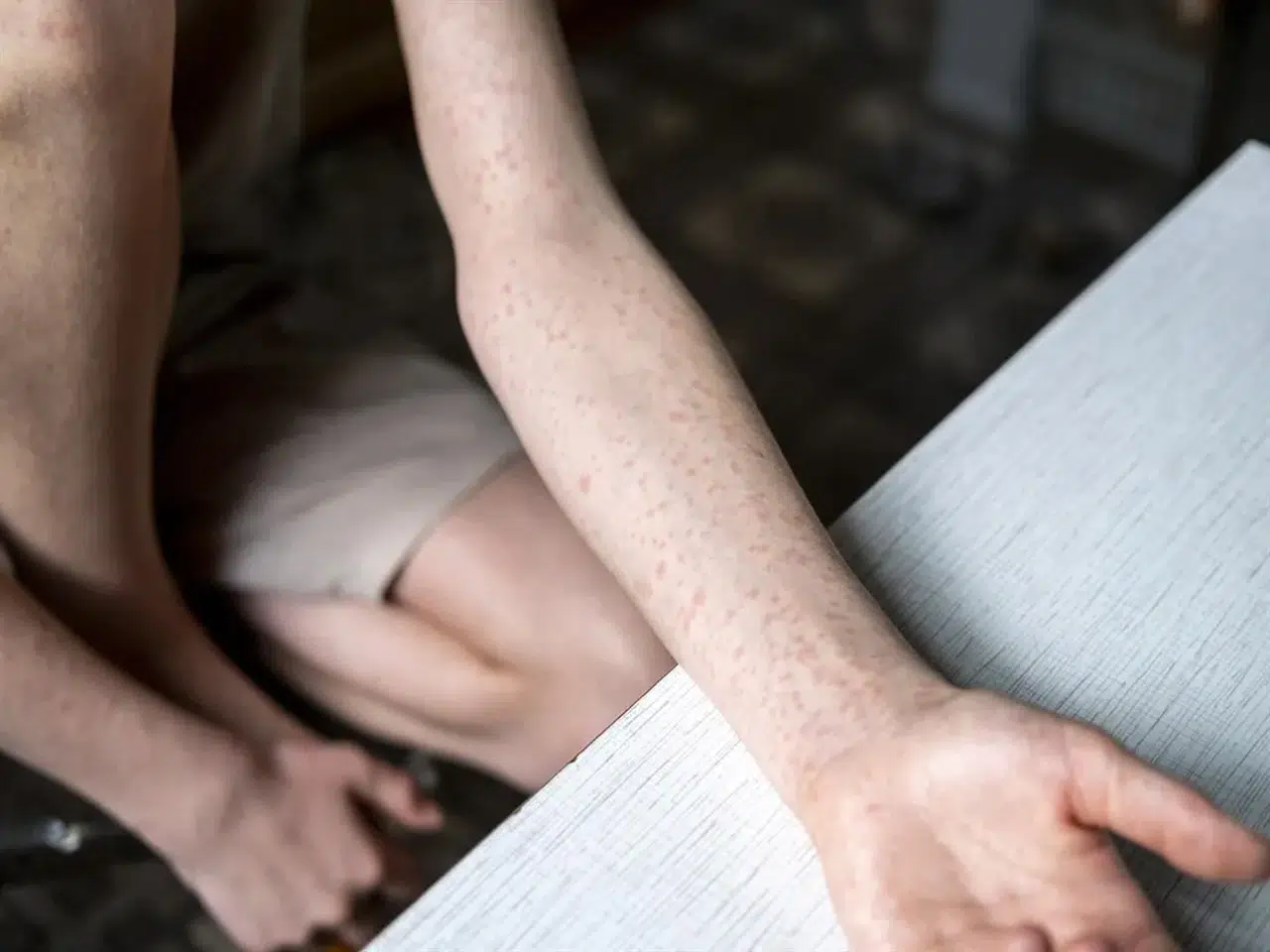 ABD'de Kızamık Salgını Endişe Veriyor: Vaka Sayıları Yükselişte