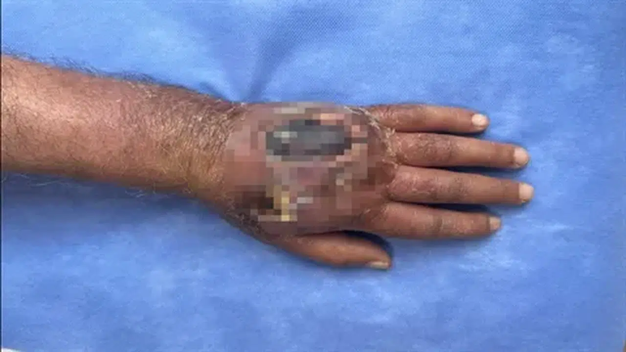 Insan ısırığı enfeksiyonu kolları kurtaran tedaviyle literatüre girecek vaka sonrası yaşananlar