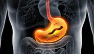 Mide Kanseri Belirtilerine Dikkat! Erken Uyarı İşaretleri Neler?