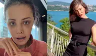 Didem Ceran’dan Yüz Nakli Sonrası Şaşırtan Açıklama: Kaşımda Saç Çıktı