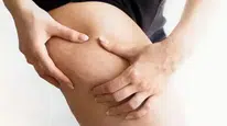Bacak sağlığında kritik ayrım: Selülit mi, lipödem mi?