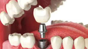 DENTAL İMPLANT SATIN ALINACAKTIR