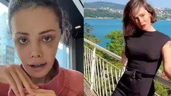 Didem Ceran’dan Yüz Nakli Sonrası Şaşırtan Açıklama: Kaşımda Saç Çıktı