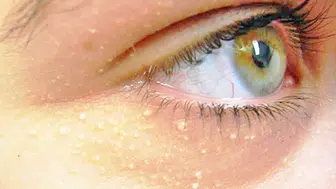 Göz Altındaki Beyaz Noktalar Nedir, Nasıl Geçer? Milia Hakkında Bilmeniz Gerekenler