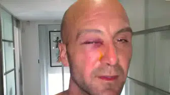 Havuzda Oyun Faciaya Dönüştü: Tatilde Gözüne Gelen Darbe Görme Yetisini Kaybettirdi