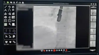 Malatya'da Yenilikçi Yöntemle Kalp Deliği Başarıyla Kapatıldı
