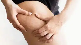 Bacak sağlığında kritik ayrım: Selülit mi, lipödem mi?