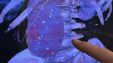 Aort damarı 11 santimetreye çıkıp patlayan hasta sağlığına kavuşturuldu