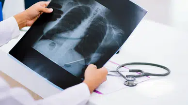 Tüberküloz: Korkma, Saklama, Tedavi Ol!