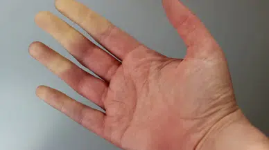Raynaud Hastalığı nedir? Raynaud Hastalığı belirtileri nelerdir? Tedavisi var mı?