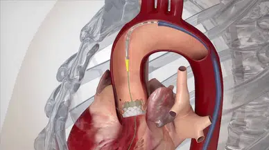 Kalp kapağı sağ boyun damarından girilerek değiştirilen hasta sağlığına kavuştu