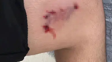 Evine giderken köpek saldırısında yaralandı