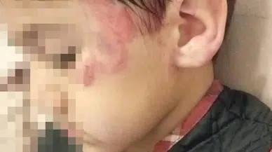 Anakulunda 4 yaşındaki çocuk 3 yaşındaki çocuğu uyurken 13 yerinden ısırdı; aile şikayetçi oldu