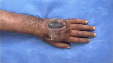 Insan ısırığı enfeksiyonu kolları kurtaran tedaviyle literatüre girecek vaka sonrası yaşananlar