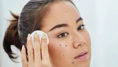 Yüzdeki Kahverengi Benler Nasıl Geçer? En Etkili Yöntemler ve Uzman Önerileri