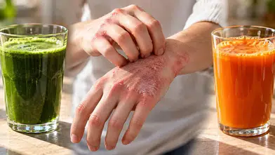 Egzamaya iyi gelen 2 sebze suyu: Kaşıntı azalıyor, cilt güzelleşiyor