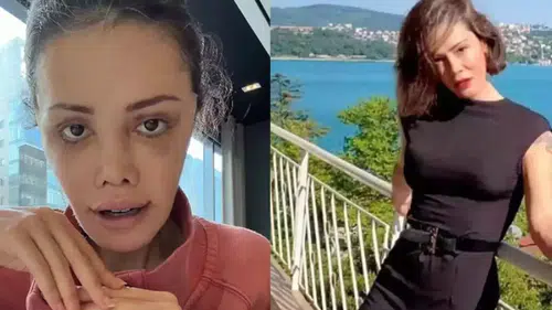 Didem Ceran’dan Yüz Nakli Sonrası Şaşırtan Açıklama: Kaşımda Saç Çıktı