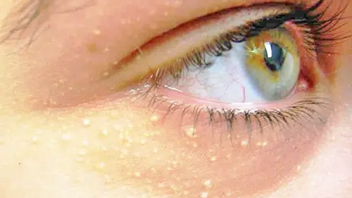 Göz Altındaki Beyaz Noktalar Nedir, Nasıl Geçer? Milia Hakkında Bilmeniz Gerekenler