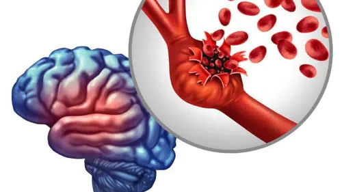 Anevrizma Nedir? Belirtileri ve Tedavi Yöntemleri