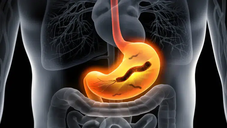 Mide Kanseri Belirtilerine Dikkat! Erken Uyarı İşaretleri Neler?