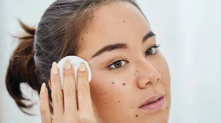 Yüzdeki Kahverengi Benler Nasıl Geçer? En Etkili Yöntemler ve Uzman Önerileri