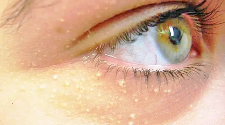 Göz Altındaki Beyaz Noktalar Nedir, Nasıl Geçer? Milia Hakkında Bilmeniz Gerekenler
