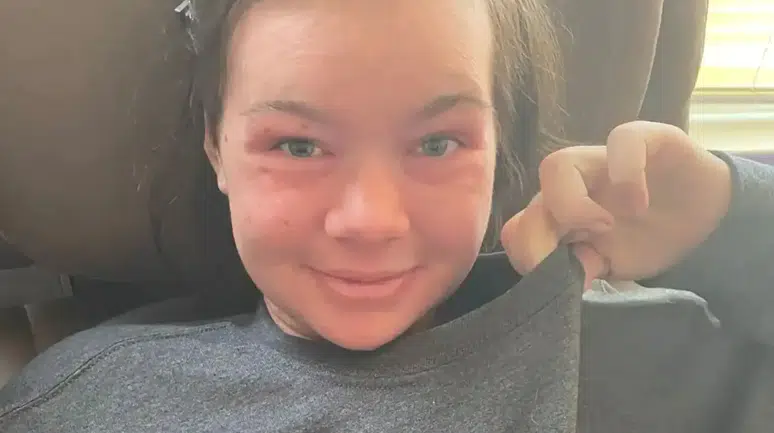 Basit Bir Döküntü Sandı, Nadir Hastalık Çıktı: 20 Yaşındaki Genç Kadının Hayatı Değişti