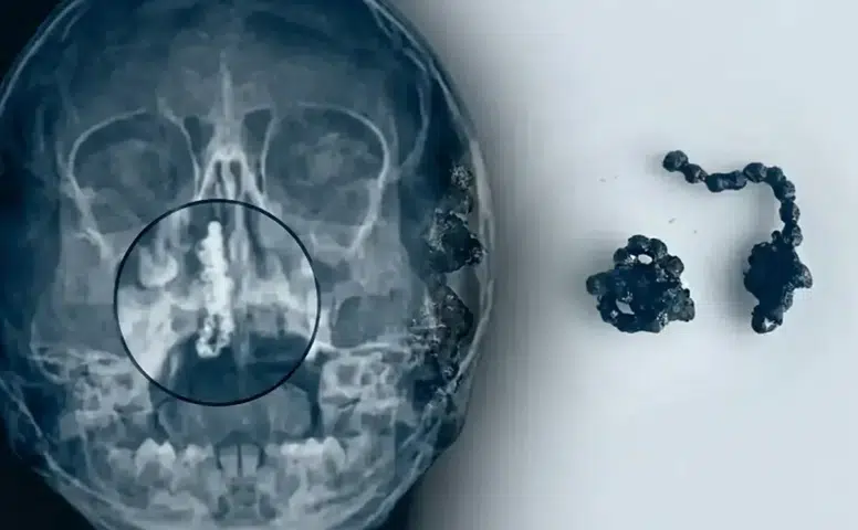 Rize’de 5 Yaşındaki Çocuğun Burnundan Çıkanlar Şaşkına Çevirdi! Aylarca Fark Edilemedi