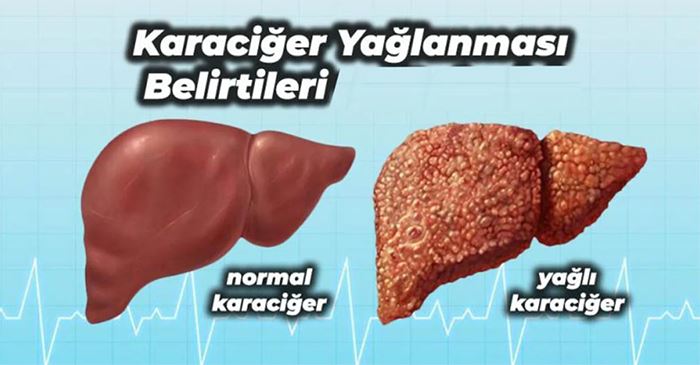 Karaciğer Yağlanması Belirtileri!