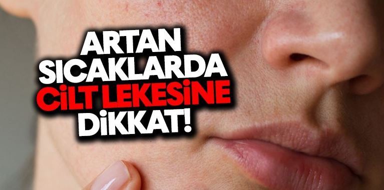  Sıcaklarda Cilt Lekesine Dikkat!