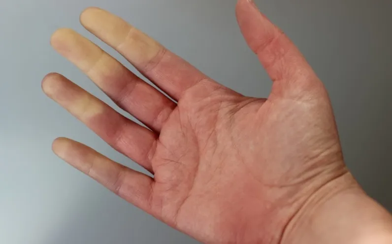 Raynaud Hastalığı nedir? Raynaud Hastalığı belirtileri nelerdir? Tedavisi var mı?